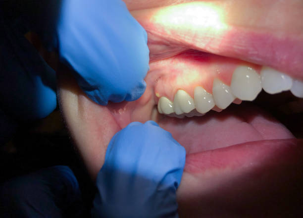 Best Emergency Tooth Extraction in Lakewood Clu, MI